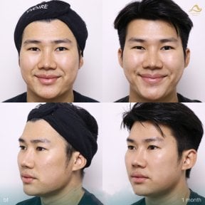 Preventative botox before and after results at Anjali Clinic, smoother forehead after 1 month