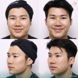 Preventative botox before and after results at Anjali Clinic, smoother forehead after 1 month