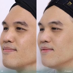 Preventative botox before and after results at Anjali Clinic, smoother forehead after 2 weeks