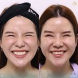 Before and after preventative botox results at Anjali Clinic, reduced smile lines in 2 weeks