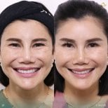 Before and after preventative botox results at Anjali Clinic, reduced facial wrinkles