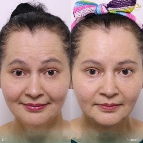 Before and after preventative botox results at Anjali Clinic, smoother forehead lines visible