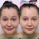 Before and after preventative botox results at Anjali Clinic, smoother forehead lines visible