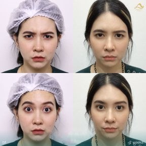 Preventative botox before and after results at Anjali Clinic, smoother forehead and frown lines