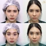 Preventative botox before and after results at Anjali Clinic, smoother forehead and frown lines
