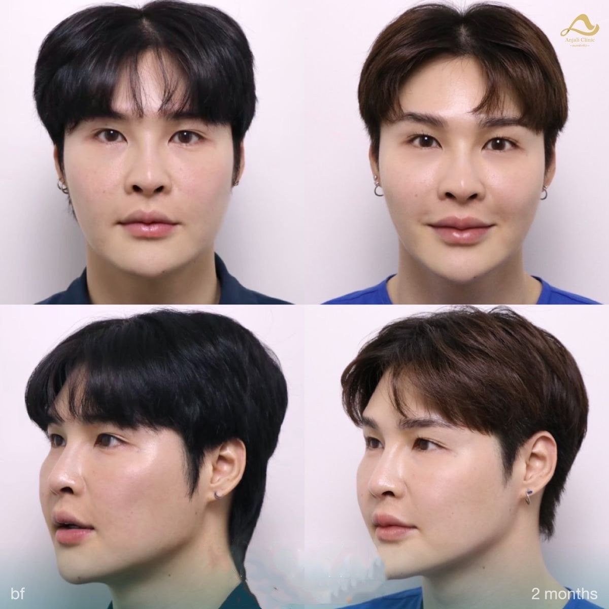 Resultados de botox preventivo en Anjali Clinic: frente y líneas faciales más suaves