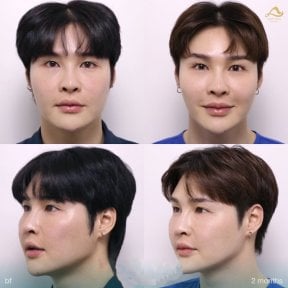 Before and after preventative botox results at Anjali Clinic, smoother forehead and facial lines