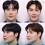 Before and after preventative botox results at Anjali Clinic, smoother forehead and facial lines