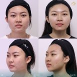 Preventative botox before and after results at Anjali Clinic, smoother skin after 1 month