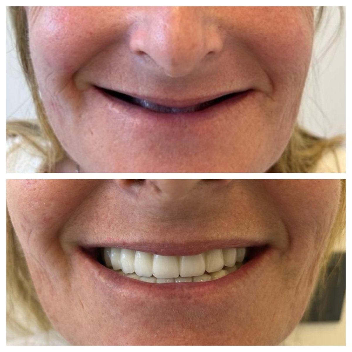 Resultados antes y después de implantes All-on-6 en My Nova Kusadasi Dental Clinic, sonrisa restaurada