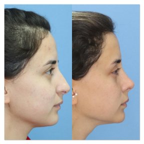 Vorher-nachher-Ergebnisse der Nasenkorrektur in der Dr. Safa Manav Klinik, Nasenform verbessert