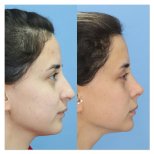 Vorher-nachher-Ergebnisse der Nasenkorrektur in der Dr. Safa Manav Klinik, Nasenform verbessert