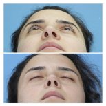 Vorher-nachher-Ergebnisse der Nasenkorrektur bei Dr. Safa Manav Clinic, verbesserte Nasensymmetrie