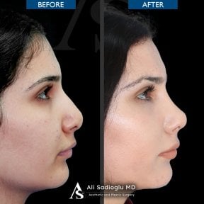 Vorher-nachher-Ergebnis der Nasenkorrektur in der Dr. Safa Manav Klinik, natürliche Form