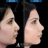 Vorher-nachher-Ergebnis der Nasenkorrektur in der Dr. Safa Manav Klinik, natürliche Form