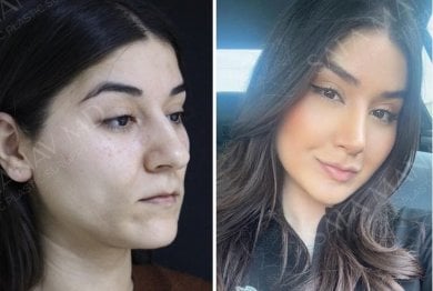 Vorher-nachher-Ergebnisse der Nasenkorrektur bei Dr. Safa Manav Clinic, Nasenformung Frau