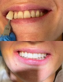 Before and after tooth whitening results at Smile Dentica Clinic – visibly brighter smile