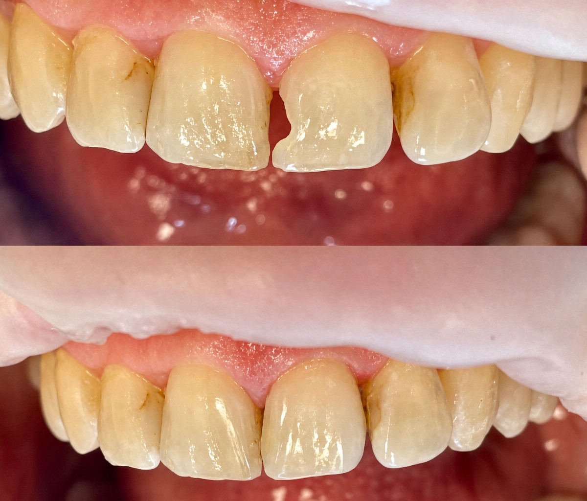نتيجة قبل وبعد حشو تجميلي مركب في Smile Dentica Clinic، ترميم الأسنان الأمامية