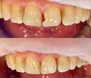 Before and after aesthetic composite filling result at Smile Dentica Clinic, front teeth repair
