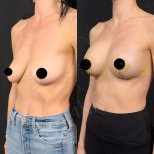 Vorher-nachher-Ergebnisse Brustvergrößerung bei Dr. Safa Manav Clinic, verbesserte Form