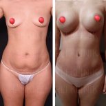 Vorher-nachher-Ergebnisse Brustvergrößerung bei Dr. Safa Manav Clinic, verbesserte Form