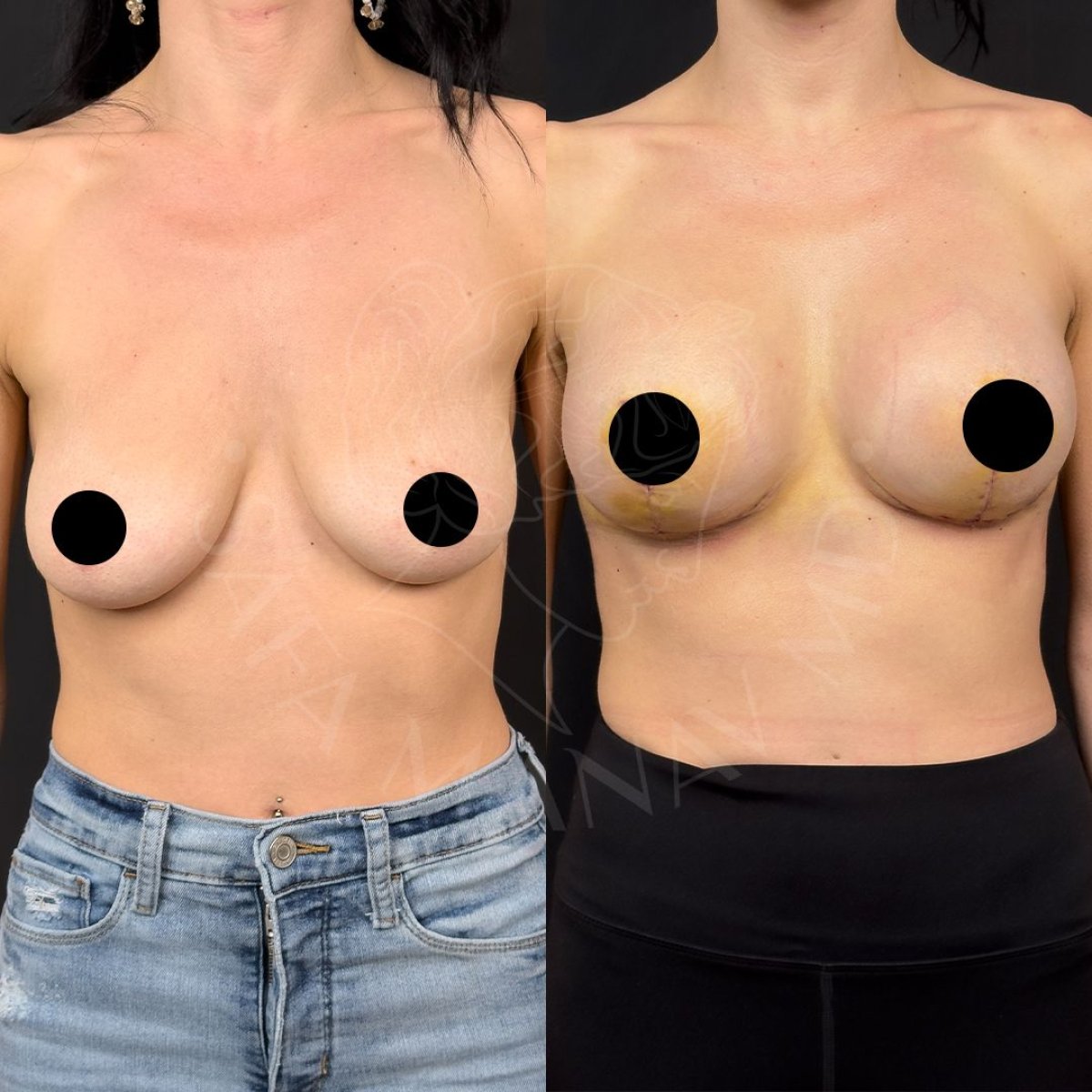 Resultados antes y después de aumento de pecho con lipofilling en Dr. Safa Manav Clinic
