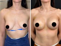 Vorher-nachher-Ergebnis Brustvergrößerung mit Eigenfett in der Dr. Safa Manav Klinik