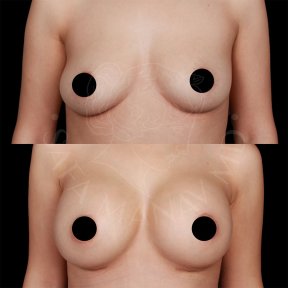 Vorher-nachher-Ergebnis Brustvergrößerung mit Eigenfett in der Dr. Safa Manav Klinik