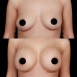 Vorher-nachher-Ergebnis Brustvergrößerung mit Eigenfett in der Dr. Safa Manav Klinik