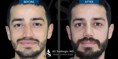 Vorher-nachher-Rhinoplastik-Ergebnis bei Dr. Safa Manav Clinic, verbesserte Nasenform Mann