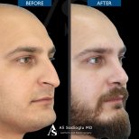 Vorher-nachher-Rhinoplastik-Ergebnisse in der Dr. Safa Manav Klinik, verbesserte Nasenform