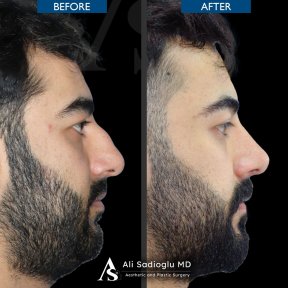 Vorher-nachher-Ergebnis der Nasenkorrektur in der Dr. Safa Manav Klinik, verbesserte Nasenform