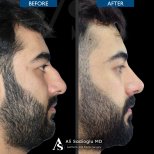 Vorher-nachher-Ergebnis der Nasenkorrektur in der Dr. Safa Manav Klinik, verbesserte Nasenform