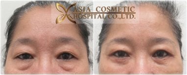 Before and after upper and lower eyelid surgery results at Asia Cosmetic Hospital