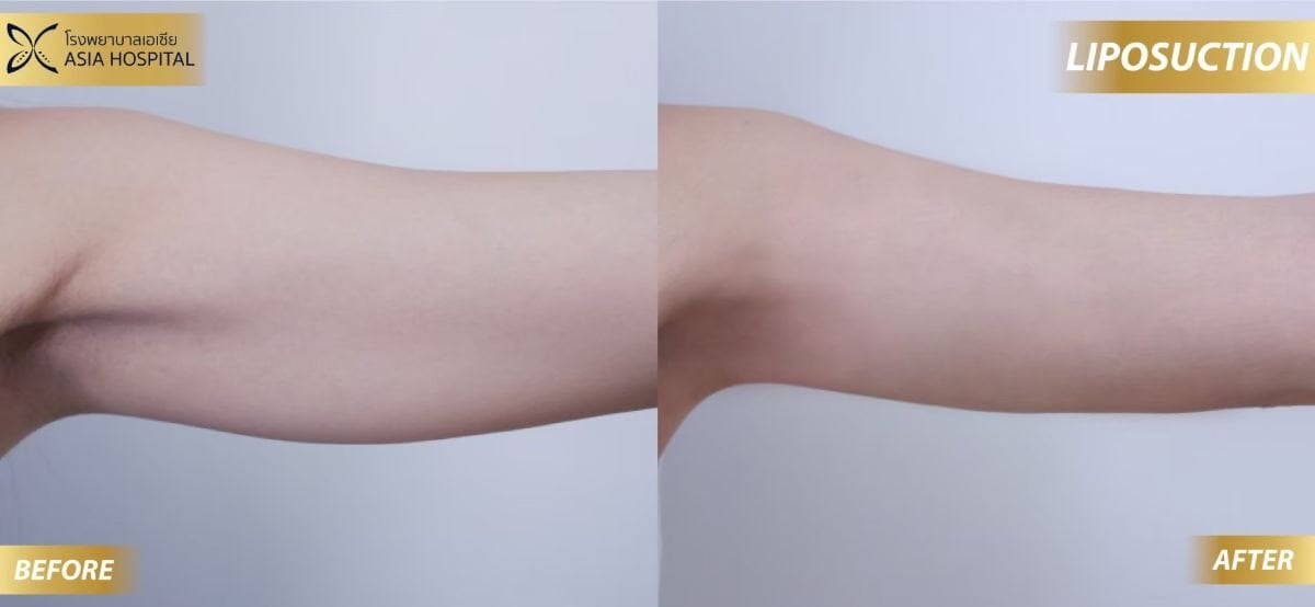 نتائج شفط الدهون بالفيزر للذراع قبل وبعد في Asia Cosmetic Hospital، تحديد أنحف
