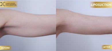 Before and after Vaser liposuction results on arm at Asia Cosmetic Hospital, slimmer contour