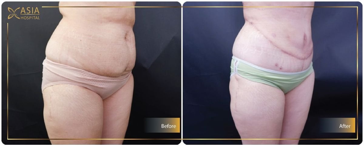 نتائج شفط الدهون فايزر قبل وبعد في Asia Cosmetic Hospital، تحسين شكل البطن