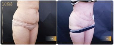 Before and after Vaser liposuction results at Asia Cosmetic Hospital, visible body contouring