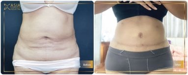 Before and after Vaser liposuction results at Asia Cosmetic Hospital, abdomen contour improved