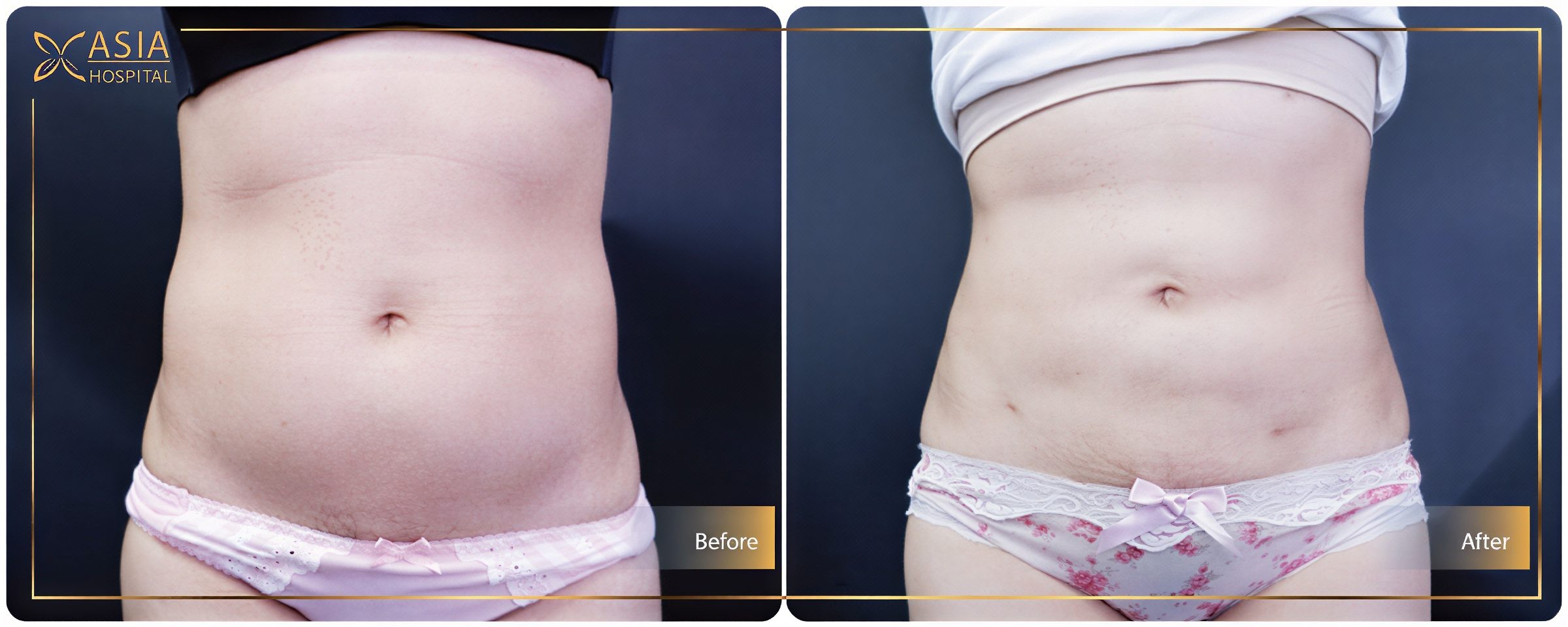 نتائج شفط الدهون فايزر قبل وبعد في Asia Cosmetic Hospital، تحسين شكل البطن