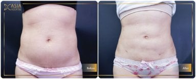 Before and after Vaser liposuction results at Asia Cosmetic Hospital, abdomen contour improvement