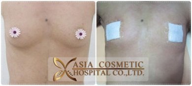 Before and after top surgery results at Asia Cosmetic Hospital, visible chest masculinization