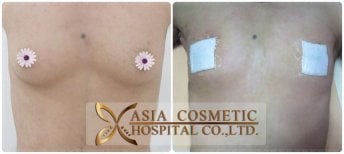 Before and after top surgery results at Asia Cosmetic Hospital, visible chest masculinization