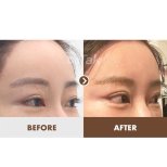Resultados antes y después de Fox Eye Lift en Dr. Tak Plastic Surgery, contorno ocular elevado