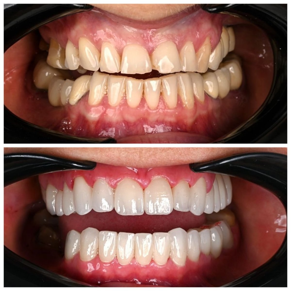Antes y después de carillas dentales en Soraca Med – sonrisa más blanca y uniforme