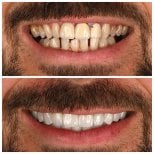 Before and after veneers at Soraca Med, smile transformation with whiter, even teeth result