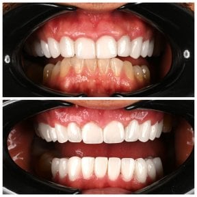 Before and after veneers at Soraca Med – smile transformation with whiter, even teeth result