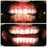 Before and after veneers at Soraca Med – smile transformation with whiter, even teeth result