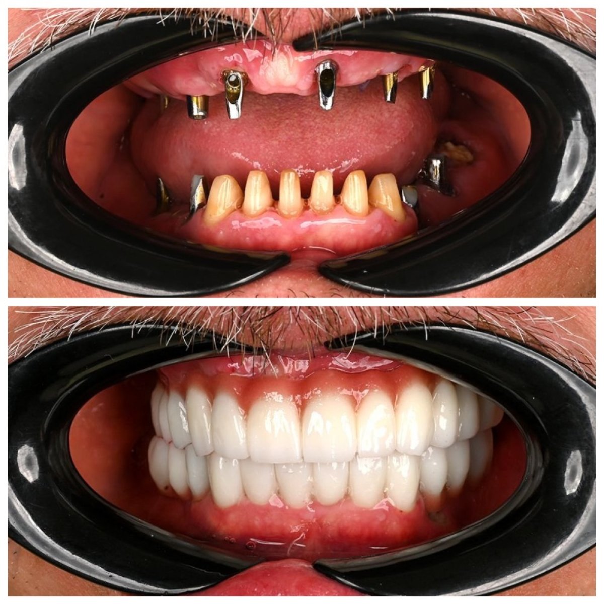 Resultados antes y después de implantes dentales en Soraca Med: restauración total de sonrisa