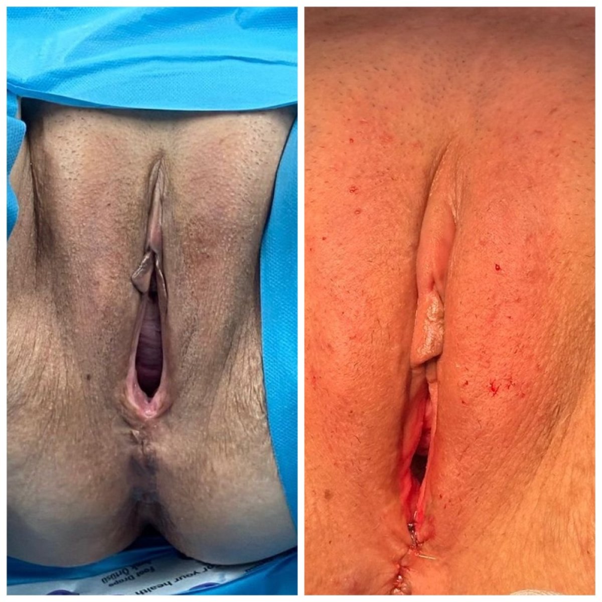 Vorher-nachher-Ergebnisse der Vaginoplastik bei Assoc. Prof. Dr. Esra Özbaşlı OBGYN & Genital Aesthetics